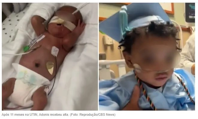 Bebê prematuro recebe alta após nascer com apenas 24 semanas: “Um milagre”