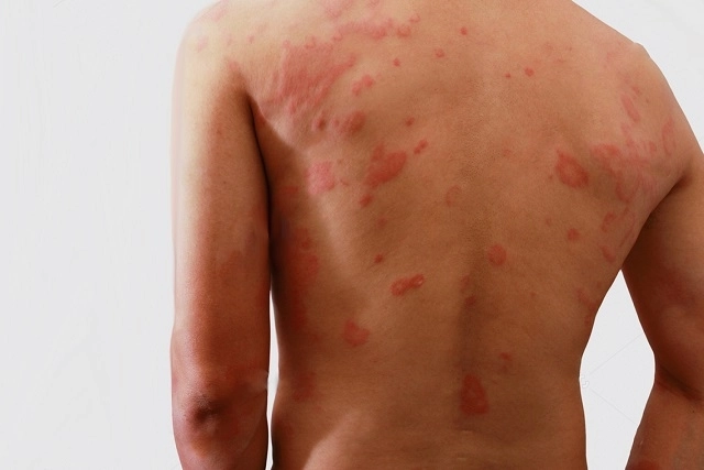 Hanseníase: diagnóstico precoce é fundamental para prevenir incapacidades e interromper a transmissão